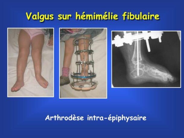 Hémimélie fibulaire